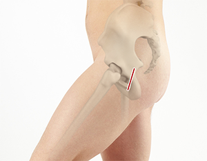 Mini-Posterior Hip Replacement New York NY